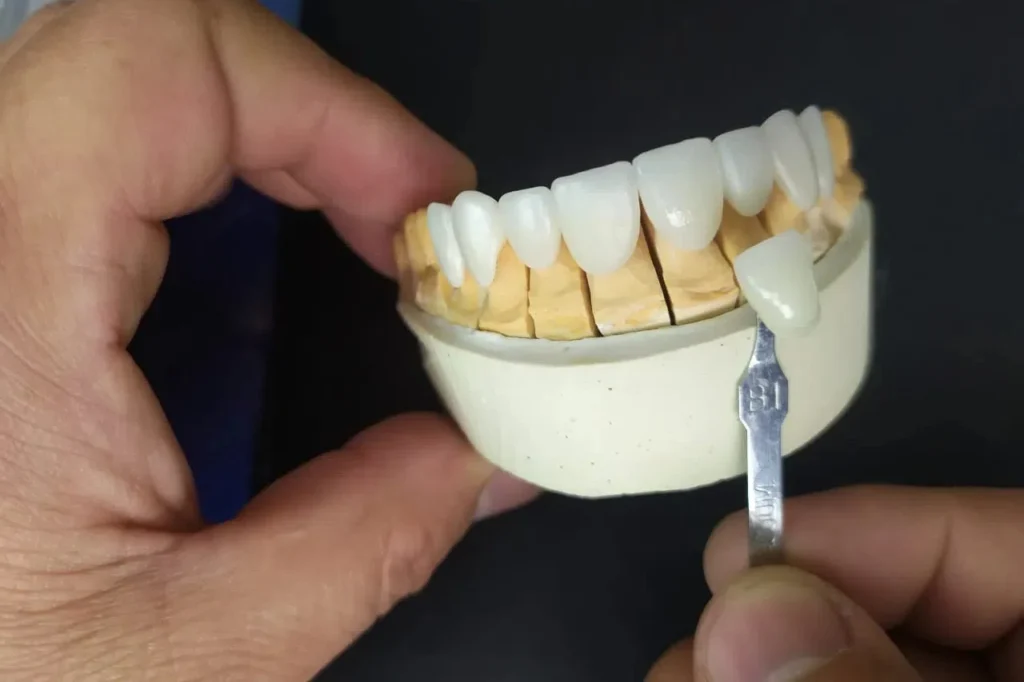 Monolithic Zirconia - 8