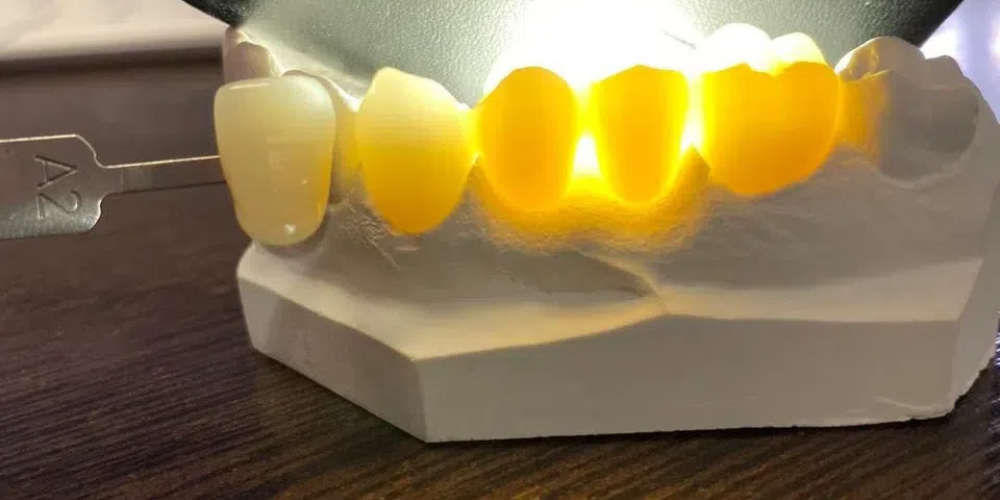 monolith dental crown