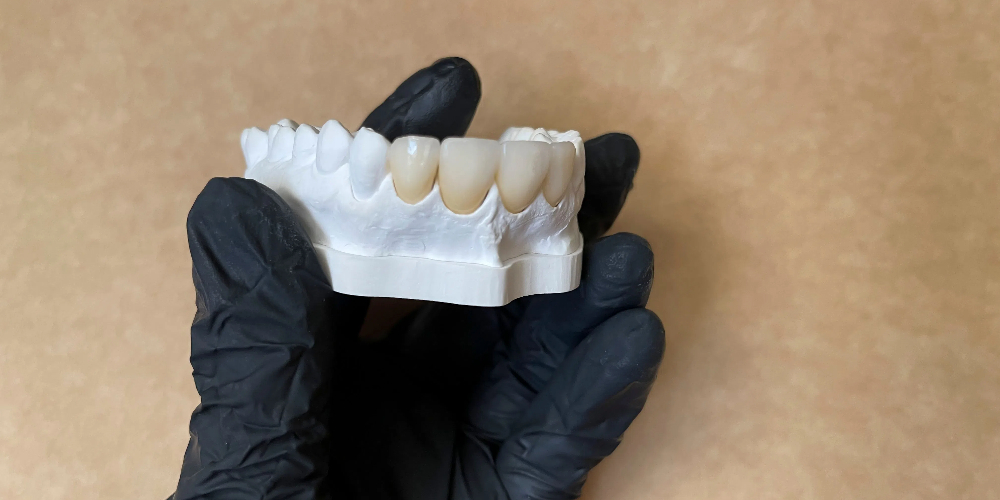 front teeth zirconia crowns