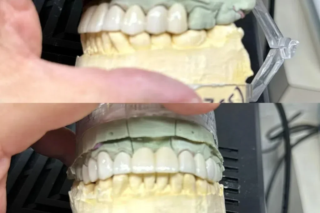 Layered Zirconia - 4