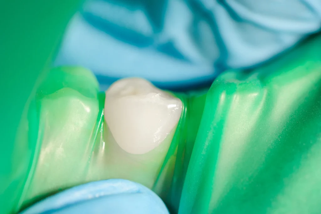 Layered Zirconia - 5