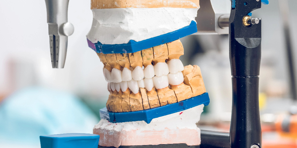 full mouth zirconia crowns