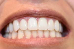 zirconia tooth cap