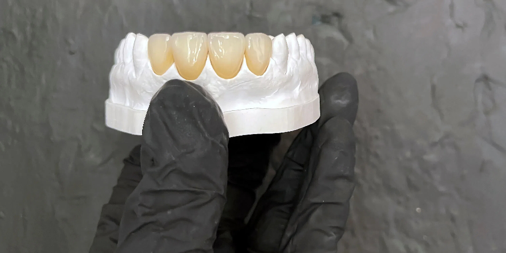 ceramic and zirconia crowns